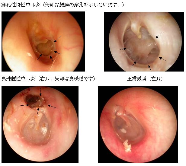 耳 舐め 中耳炎