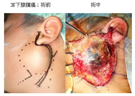 唾液腺腫瘍 - 総合病院 土浦協同病院
